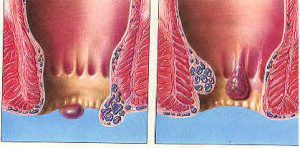 Hemorroides-2